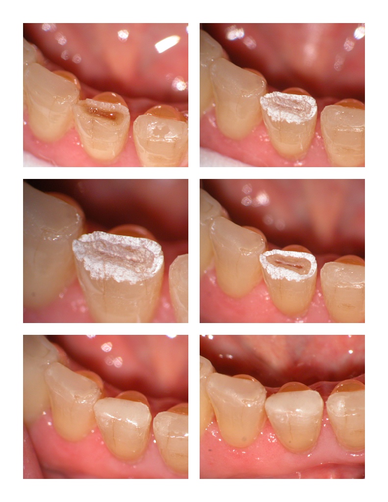 Laser for incisal edges.jpg